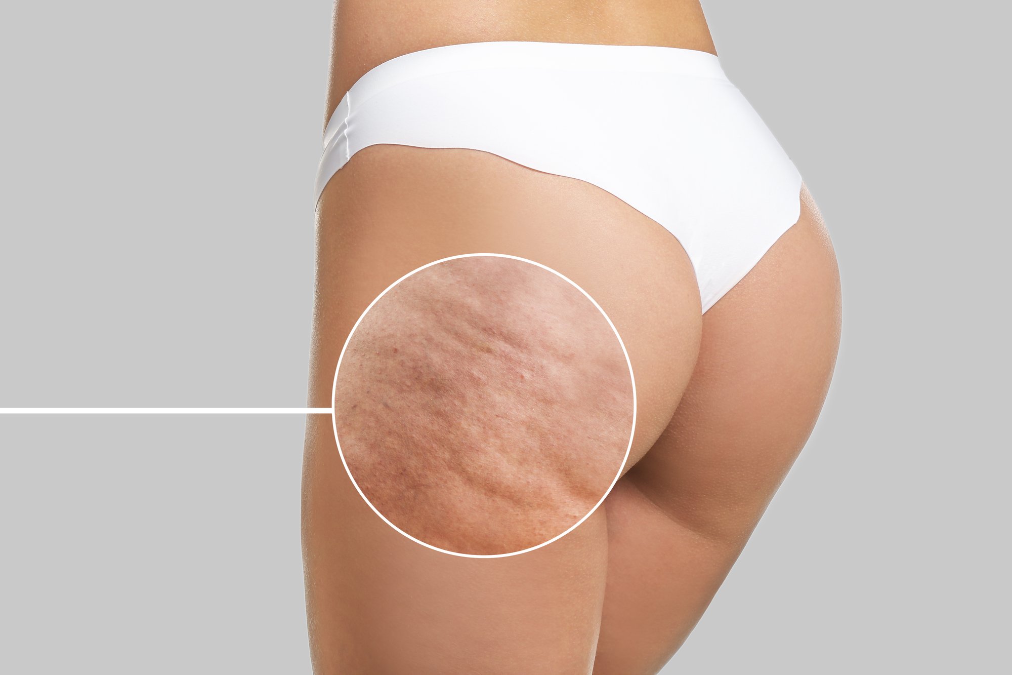 SlimSpec the Science behind Cellulite Reduction